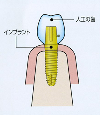 インプラント