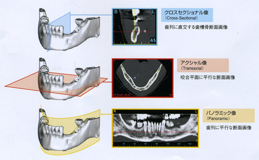 インプラント 3D画像