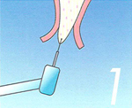 大口式インプラント法手順 1