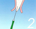 大口式インプラント法手順 2