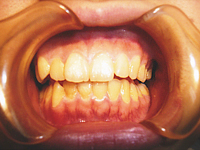 ナノハイドロキシアパタイト使用前の状態