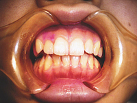 2.歯面をなめらかに