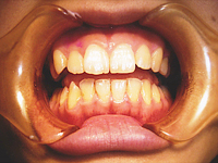 3.歯垢を吸着除去