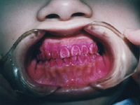 歯垢の染め出し(1)